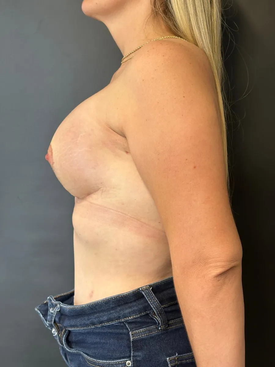 Breast Lift with Implants — Profile — after