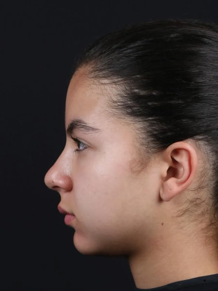 Rhinoplasty — Profile — before