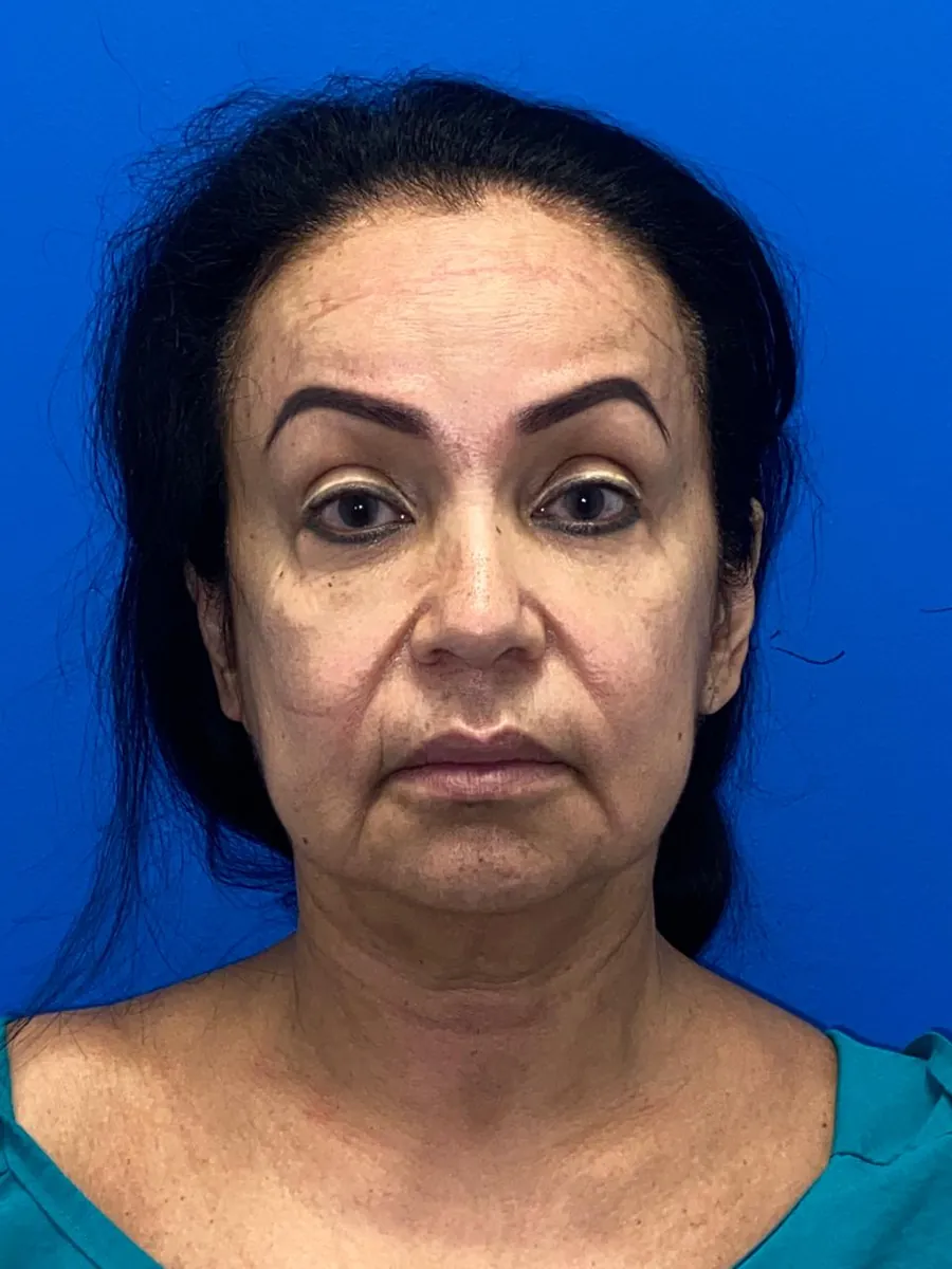 Facelift — before