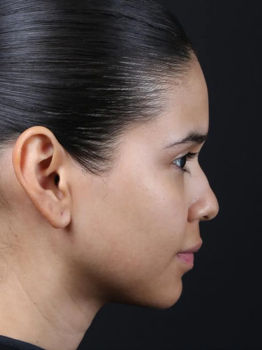 Rhinoplasty — Profile — before