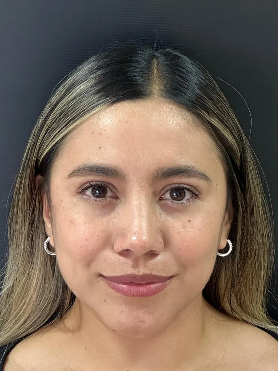 Rhinoplasty — after