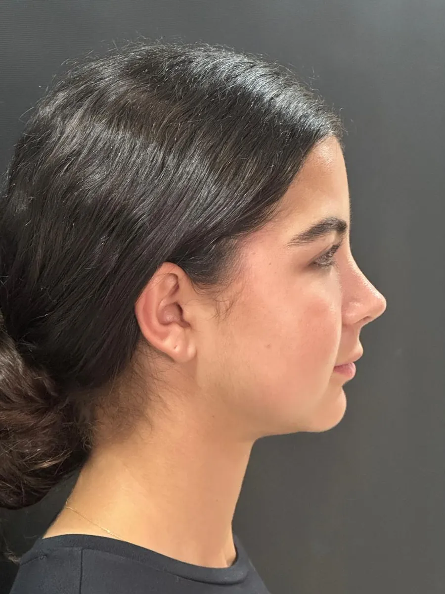 Rhinoplasty — Profile — after