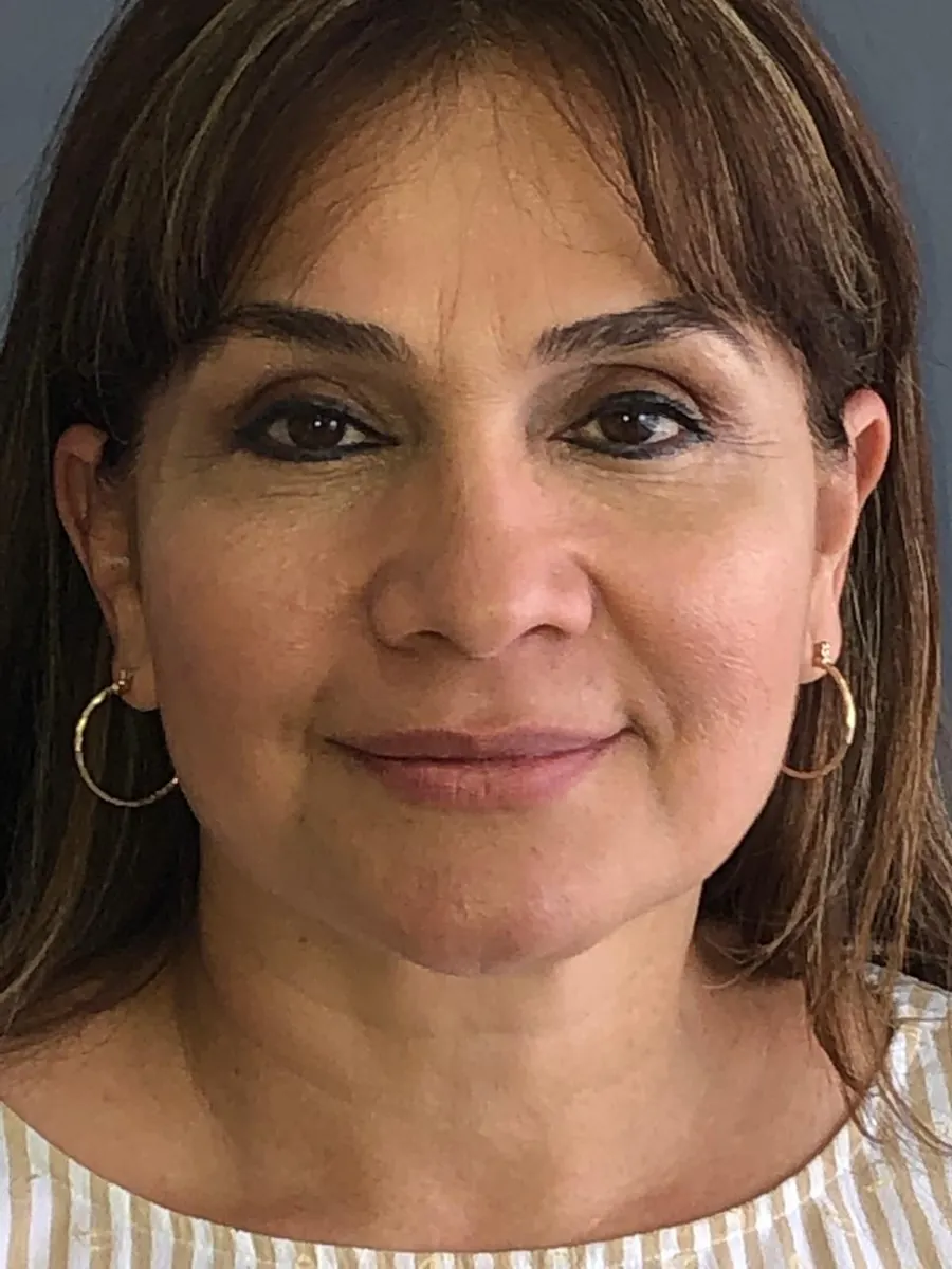 Blepharoplasty (Eyelid Surgery) — after