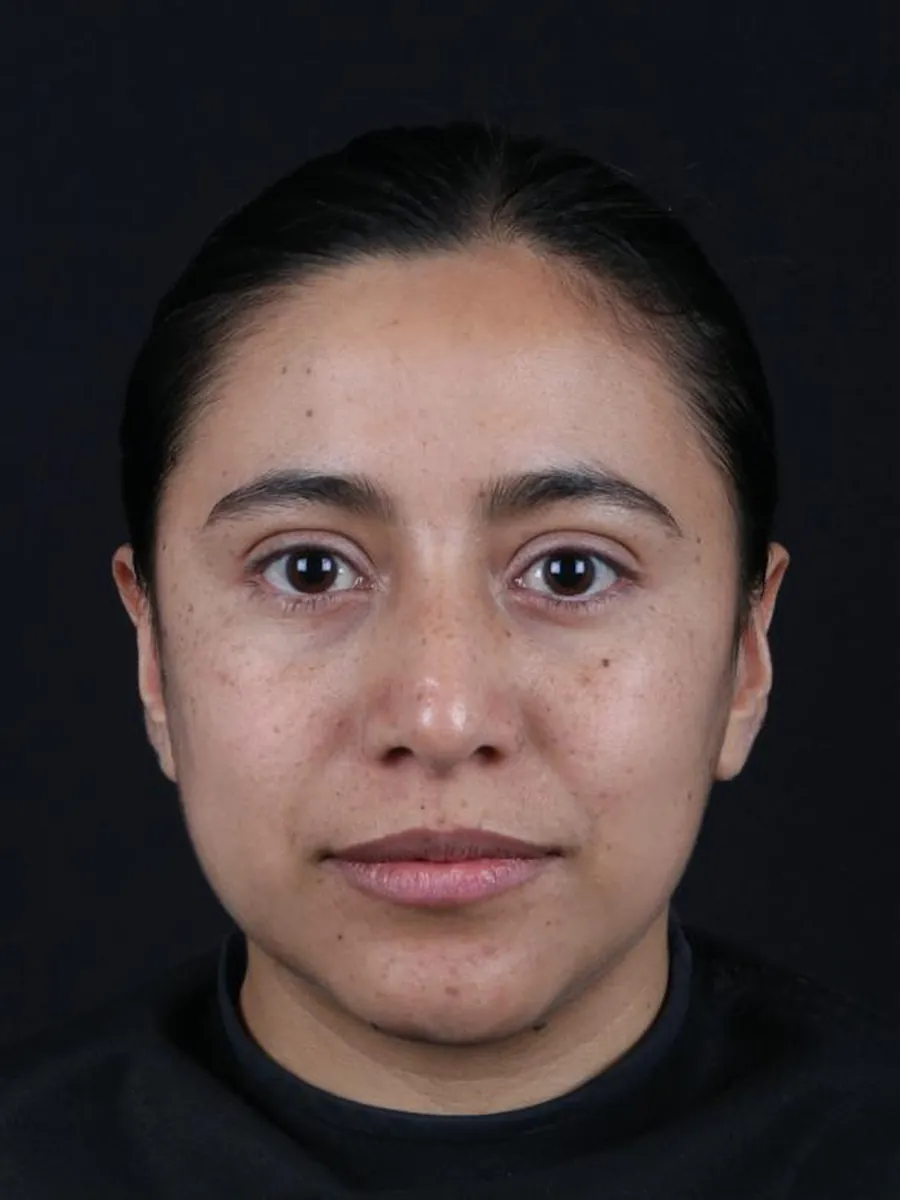 Rhinoplasty — before