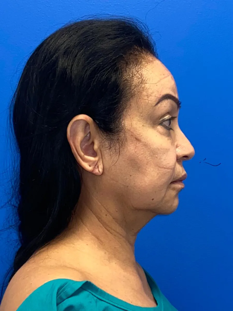 Facelift — Profile — before