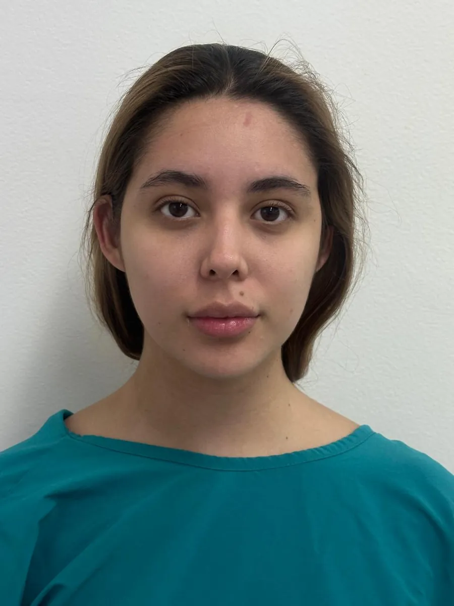 Rhinoplasty — before