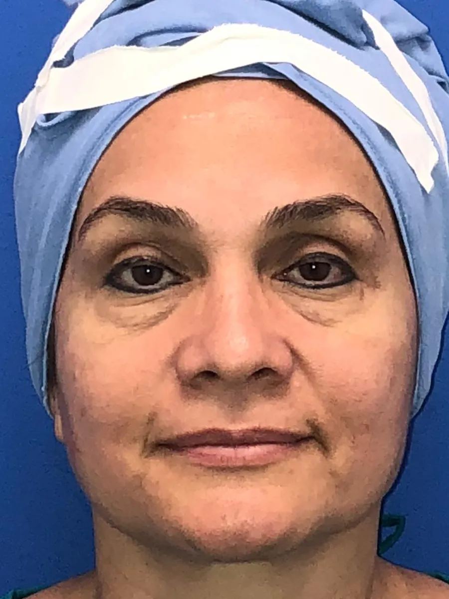 Blepharoplasty (Eyelid Surgery) — before