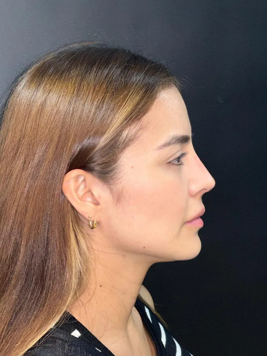 Revision Rhinoplasty — Profile — after