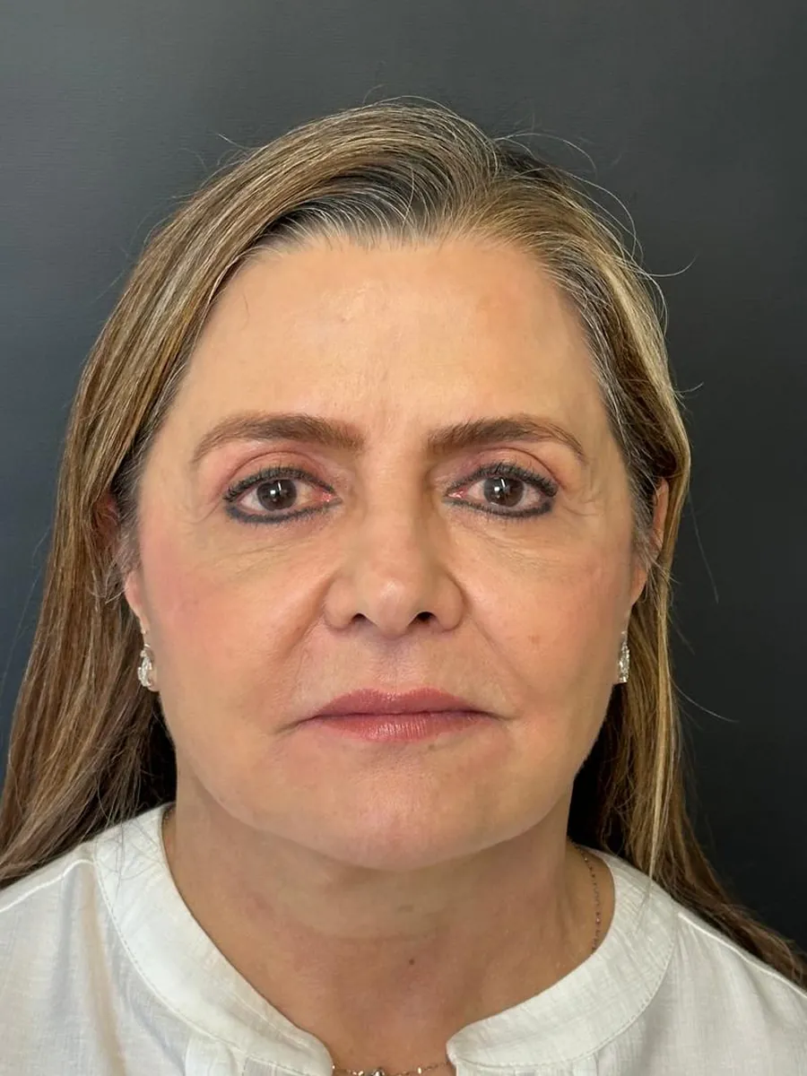 Facelift — after