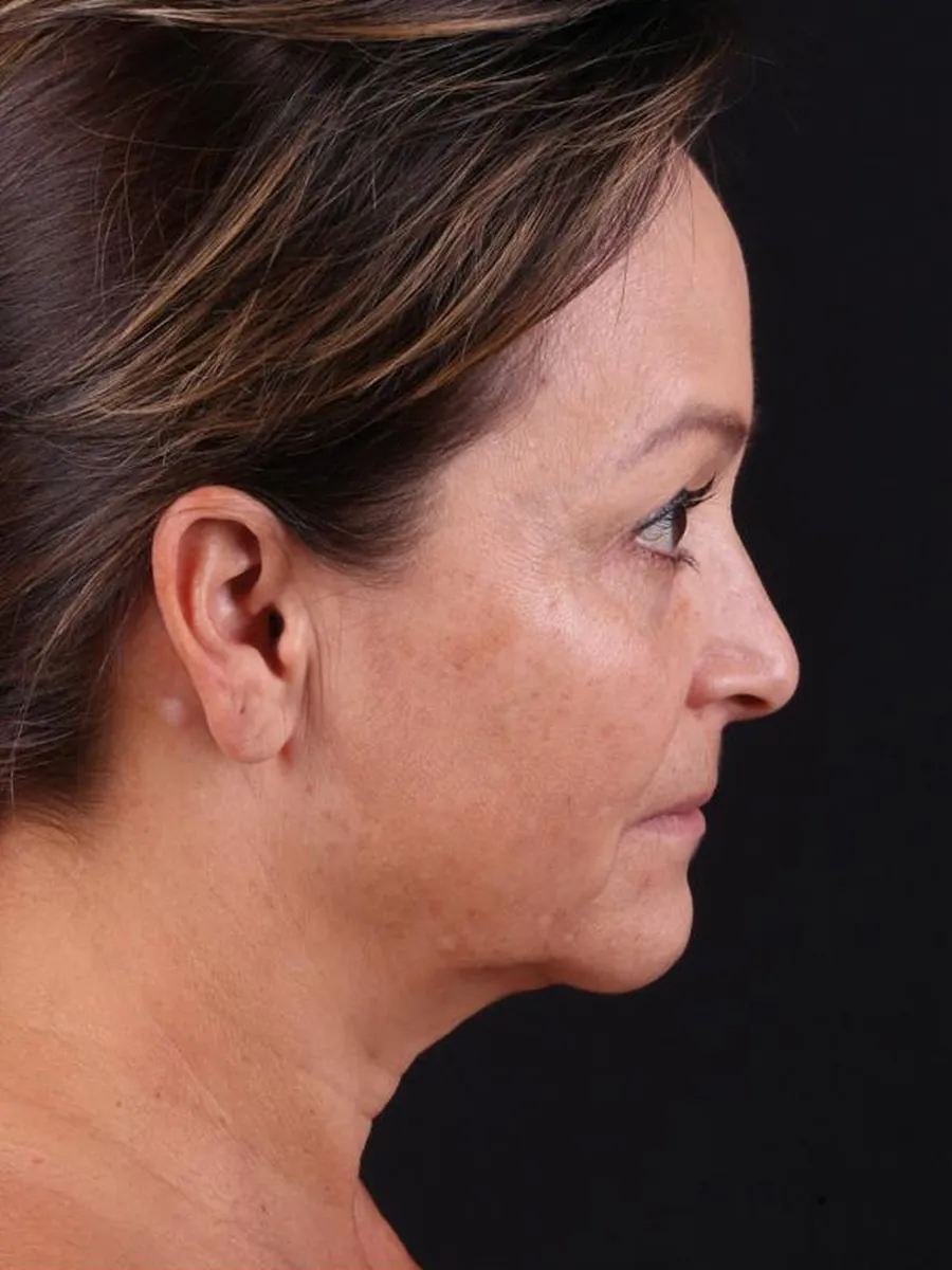 Facelift — Profile — before