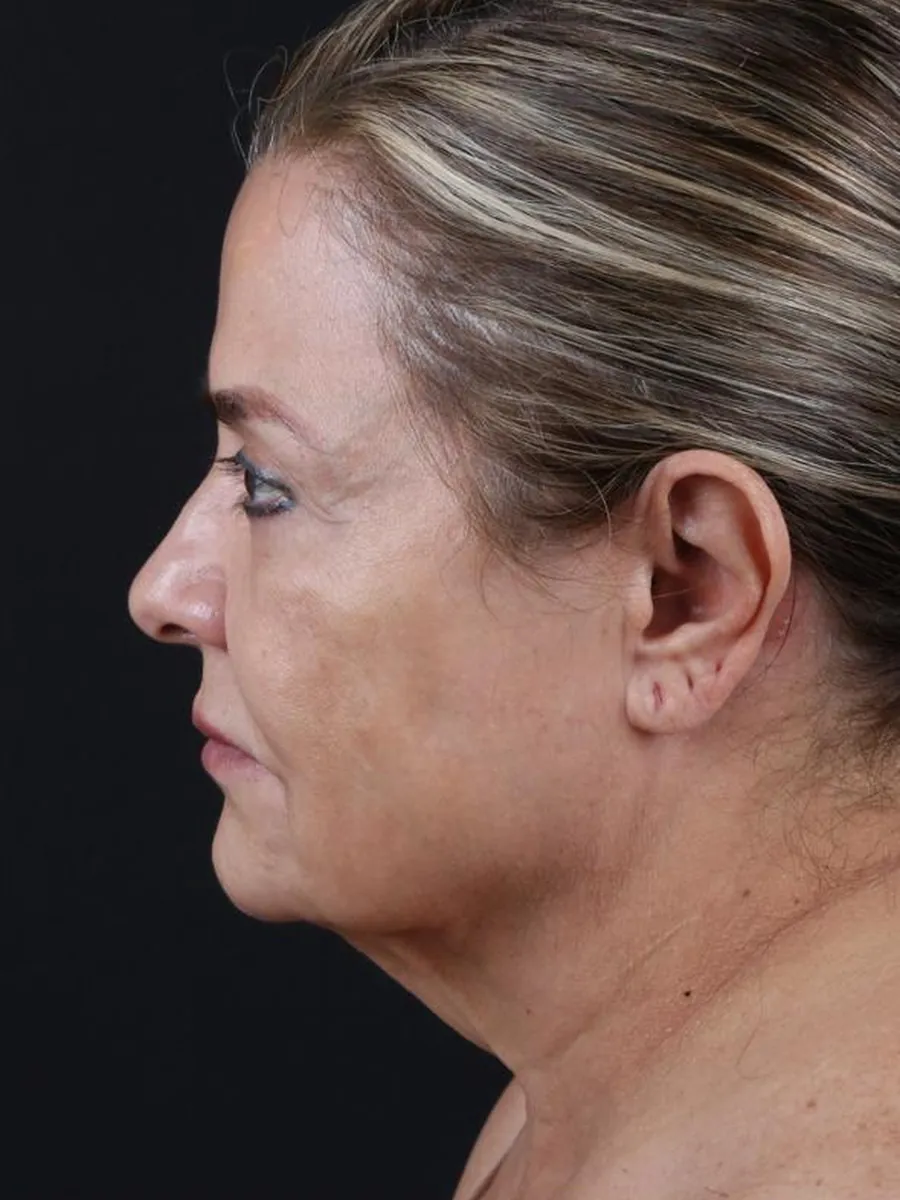 Facelift — Profile — before