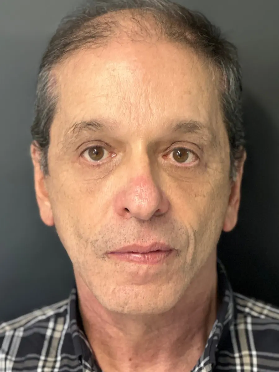 Facial Rejuvenation — after