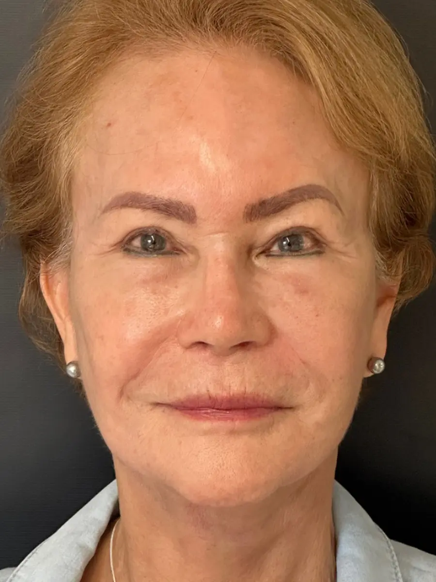 Facial Rejuvenation — after