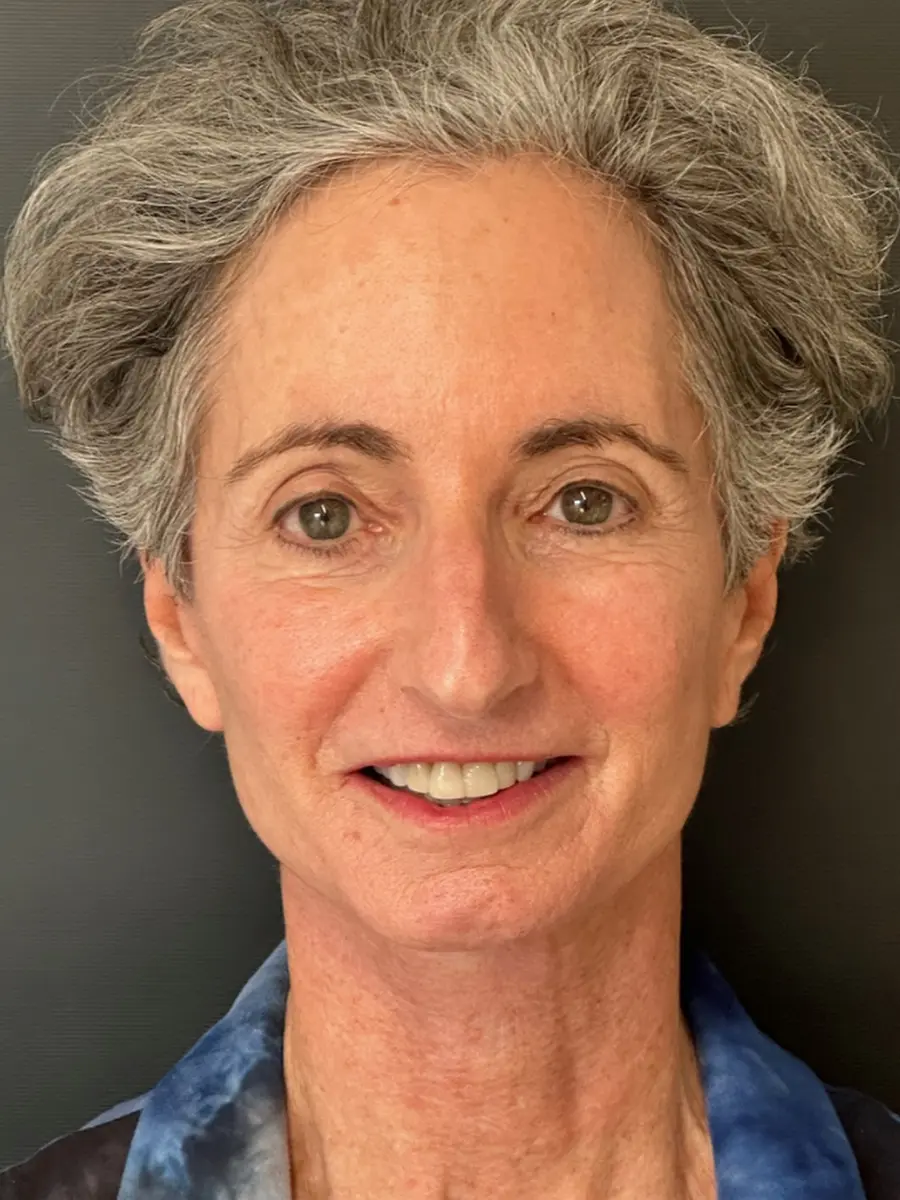 Facial Rejuvenation — after