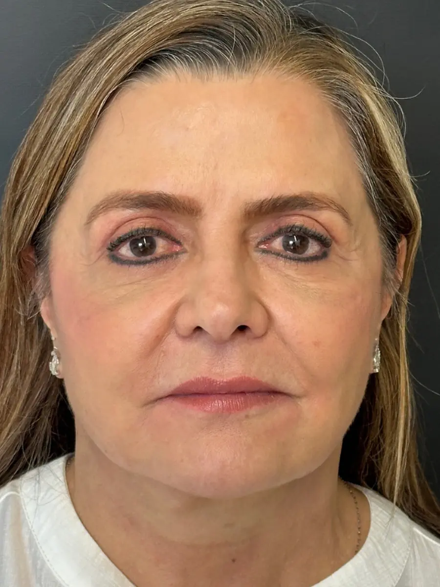 Facial Rejuvenation — after