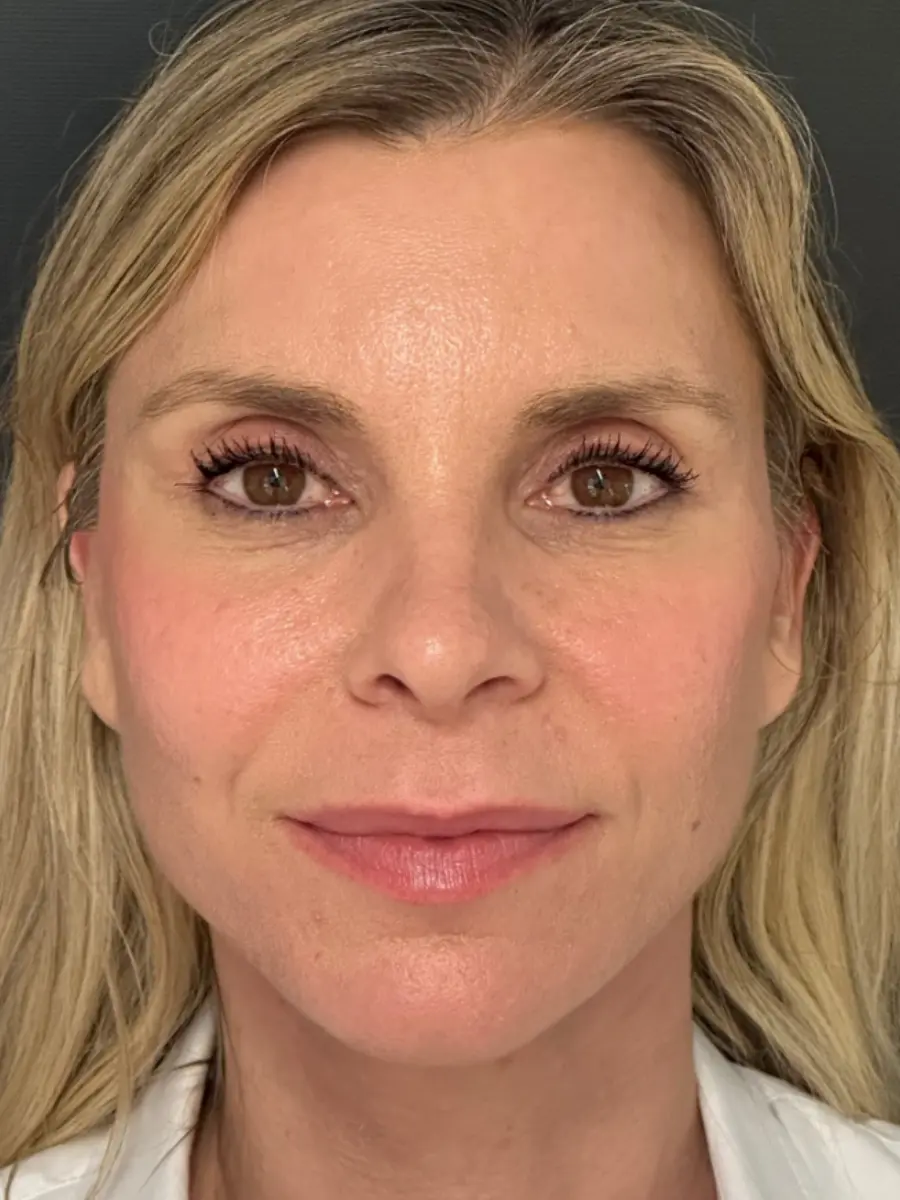 Facial Rejuvenation — after