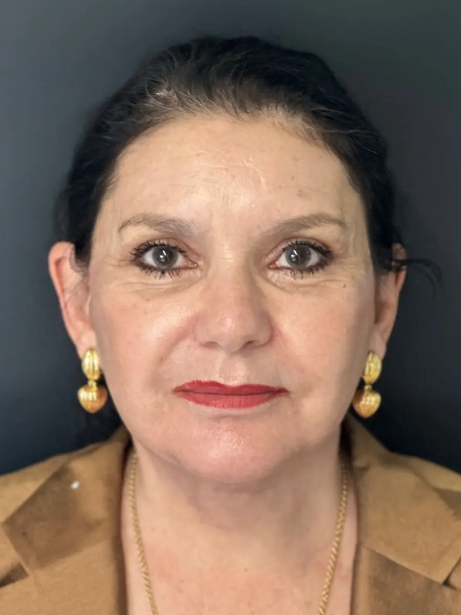 Facial Rejuvenation — after