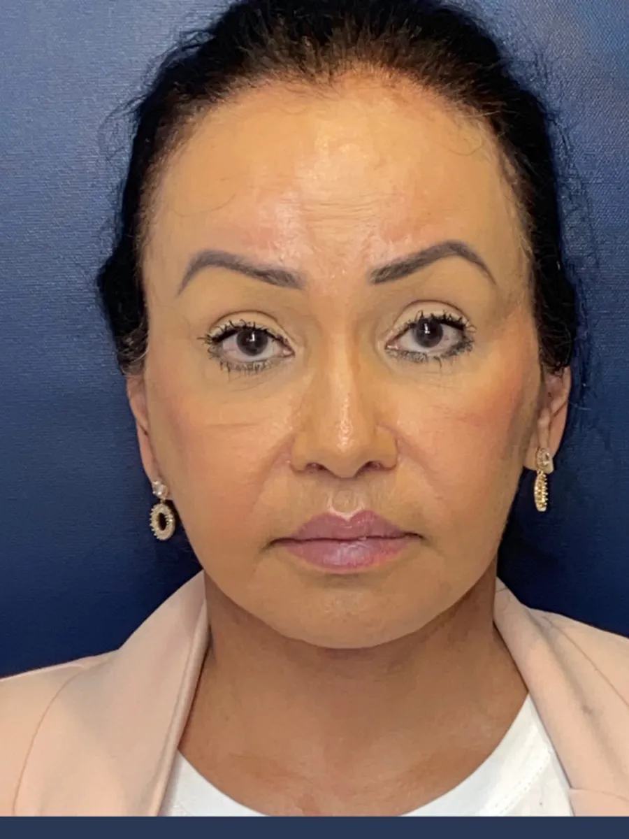 Facial Rejuvenation — after