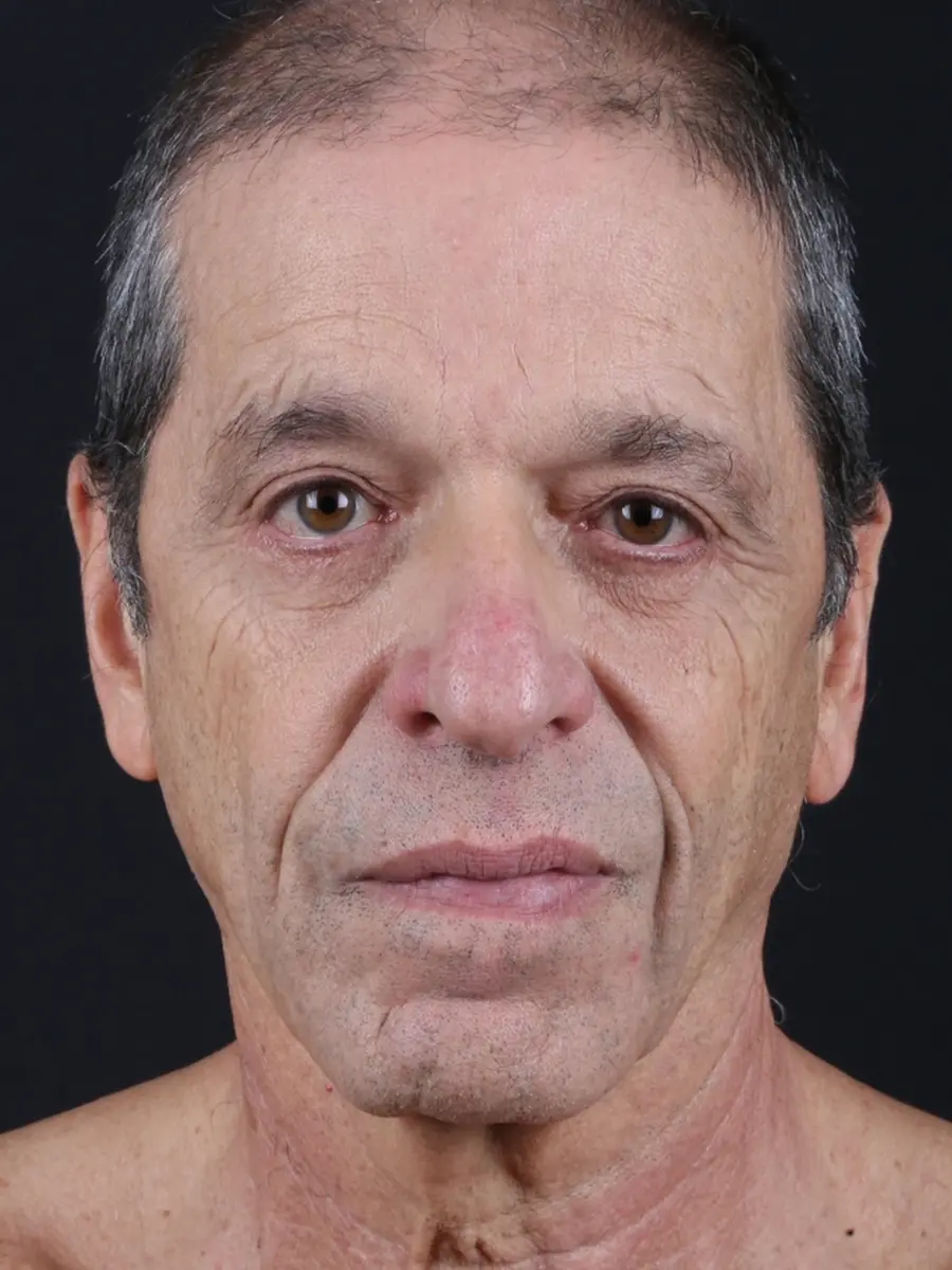 Facial Rejuvenation — before