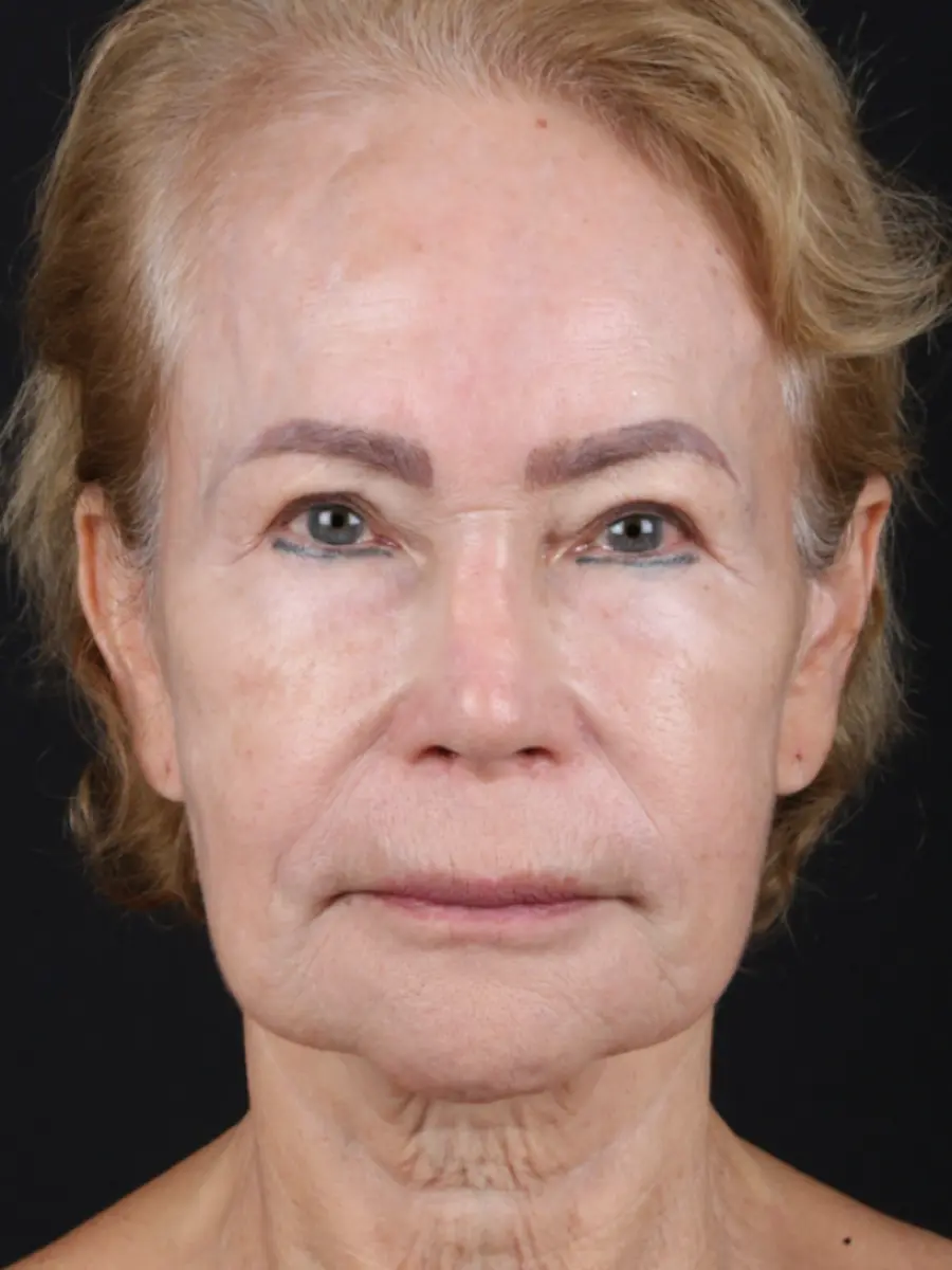 Facial Rejuvenation — before