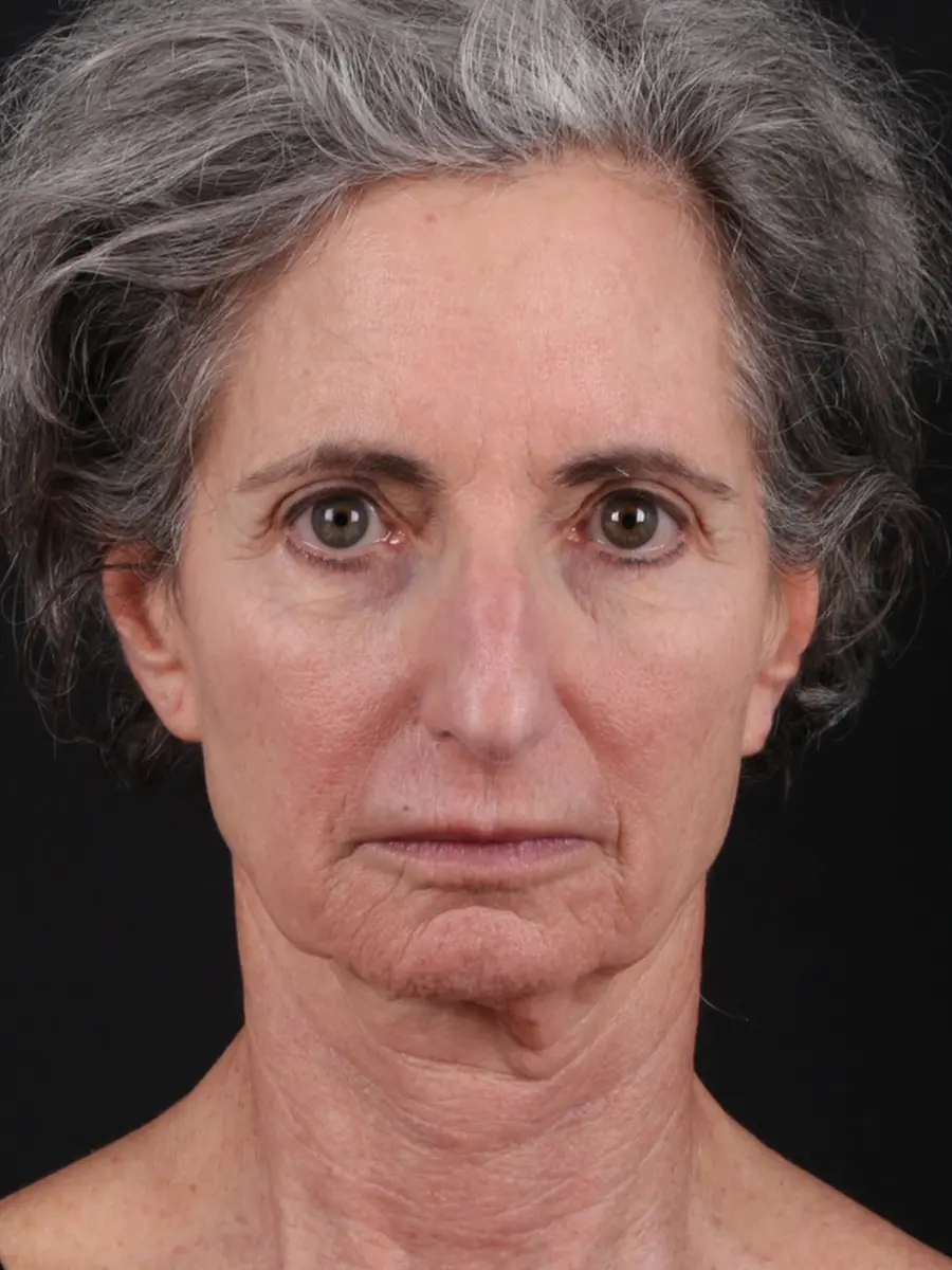 Facial Rejuvenation — before