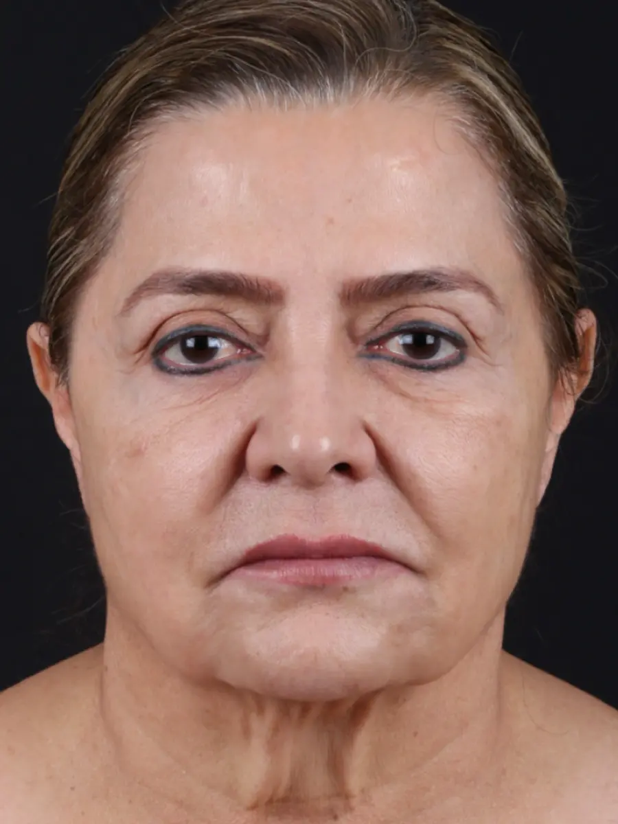 Facial Rejuvenation — before