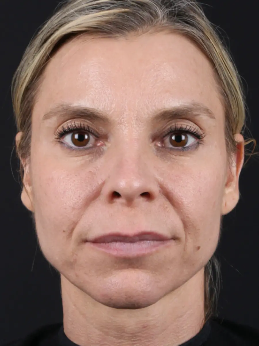 Facial Rejuvenation — before