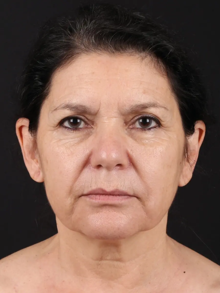 Facial Rejuvenation — before