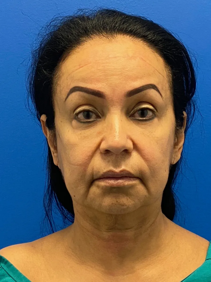 Facial Rejuvenation — before