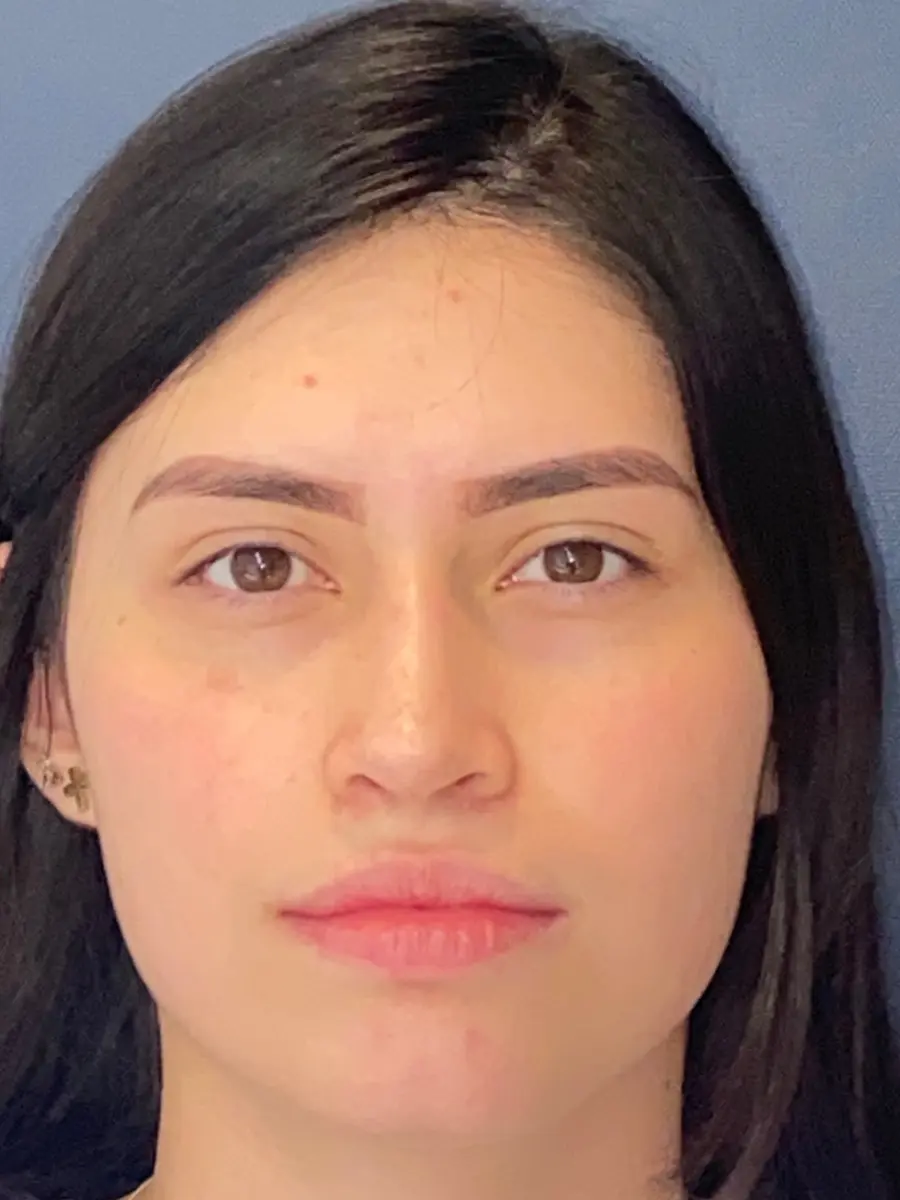 Rhinoplasty — after