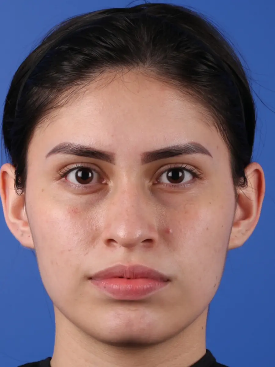 Rhinoplasty — before