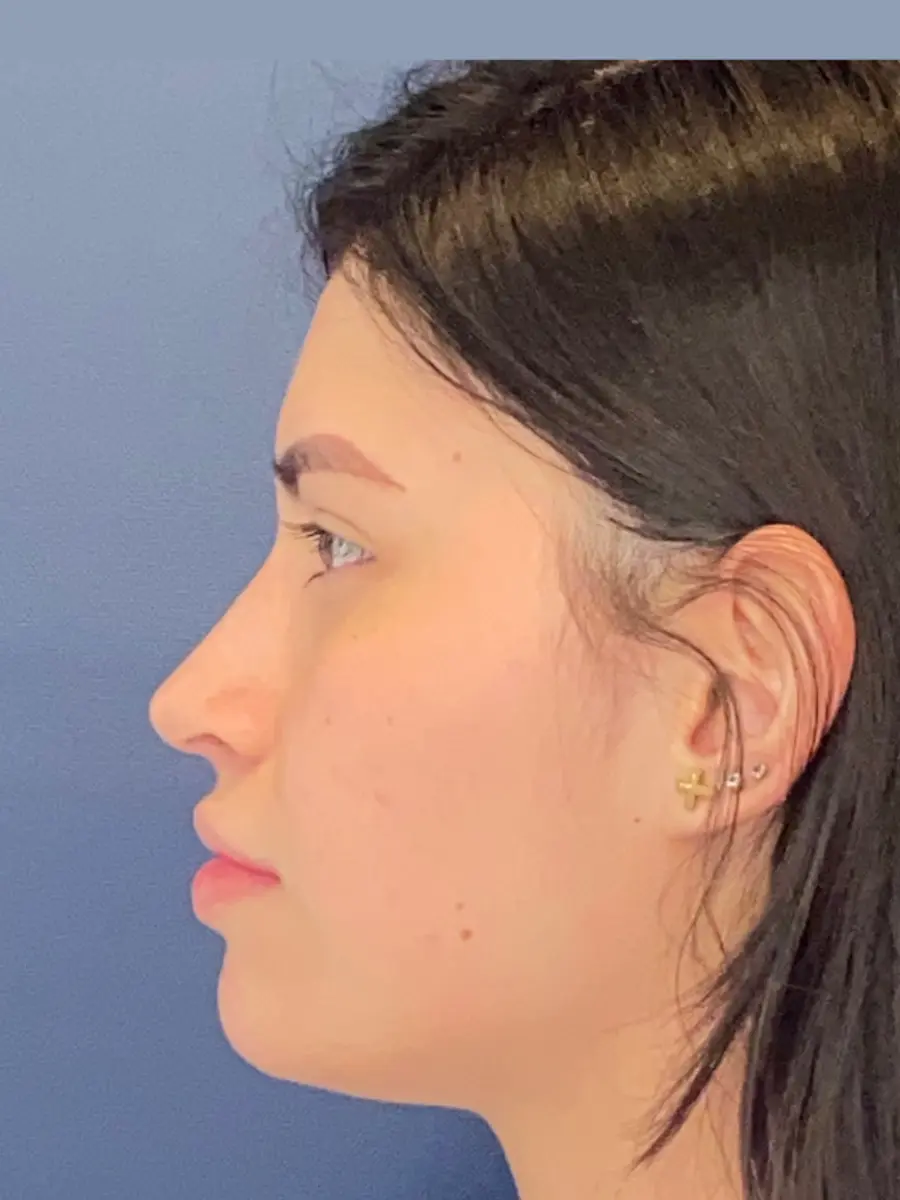 Rhinoplasty — Profile — after