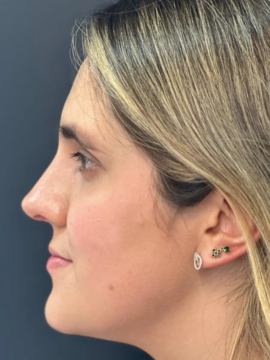 Rhinoplasty — Profile — after