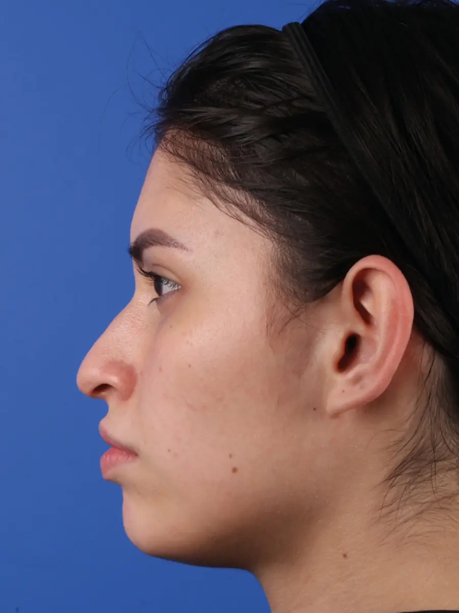 Rhinoplasty — Profile — before