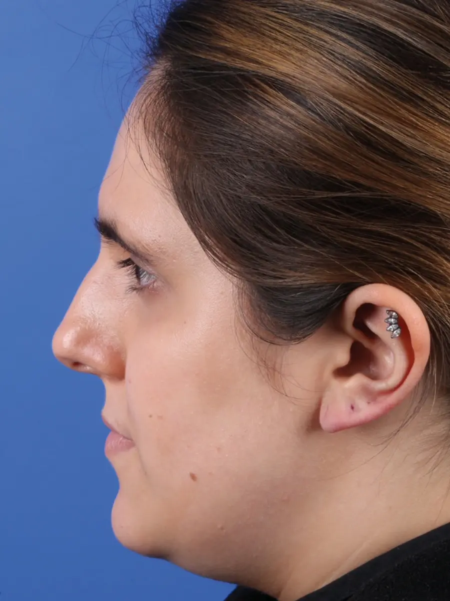 Rhinoplasty — Profile — before