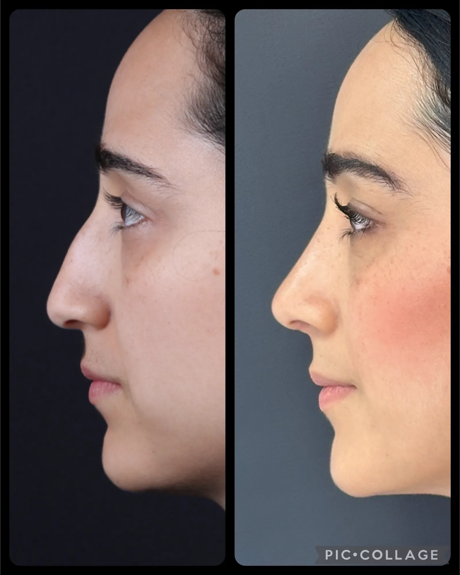 Rhinoplasty — Profile — before and after