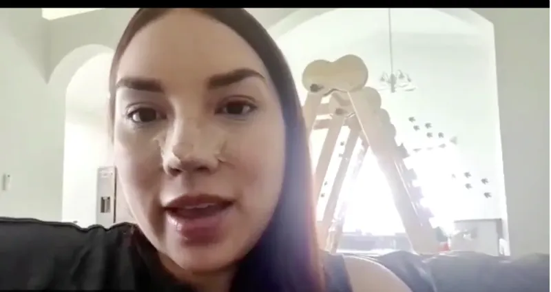 Louisa — West Palm Beach · Rhinoplasty + Implant Exchange